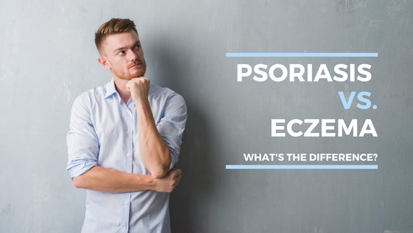 psoriasis vs. eczema