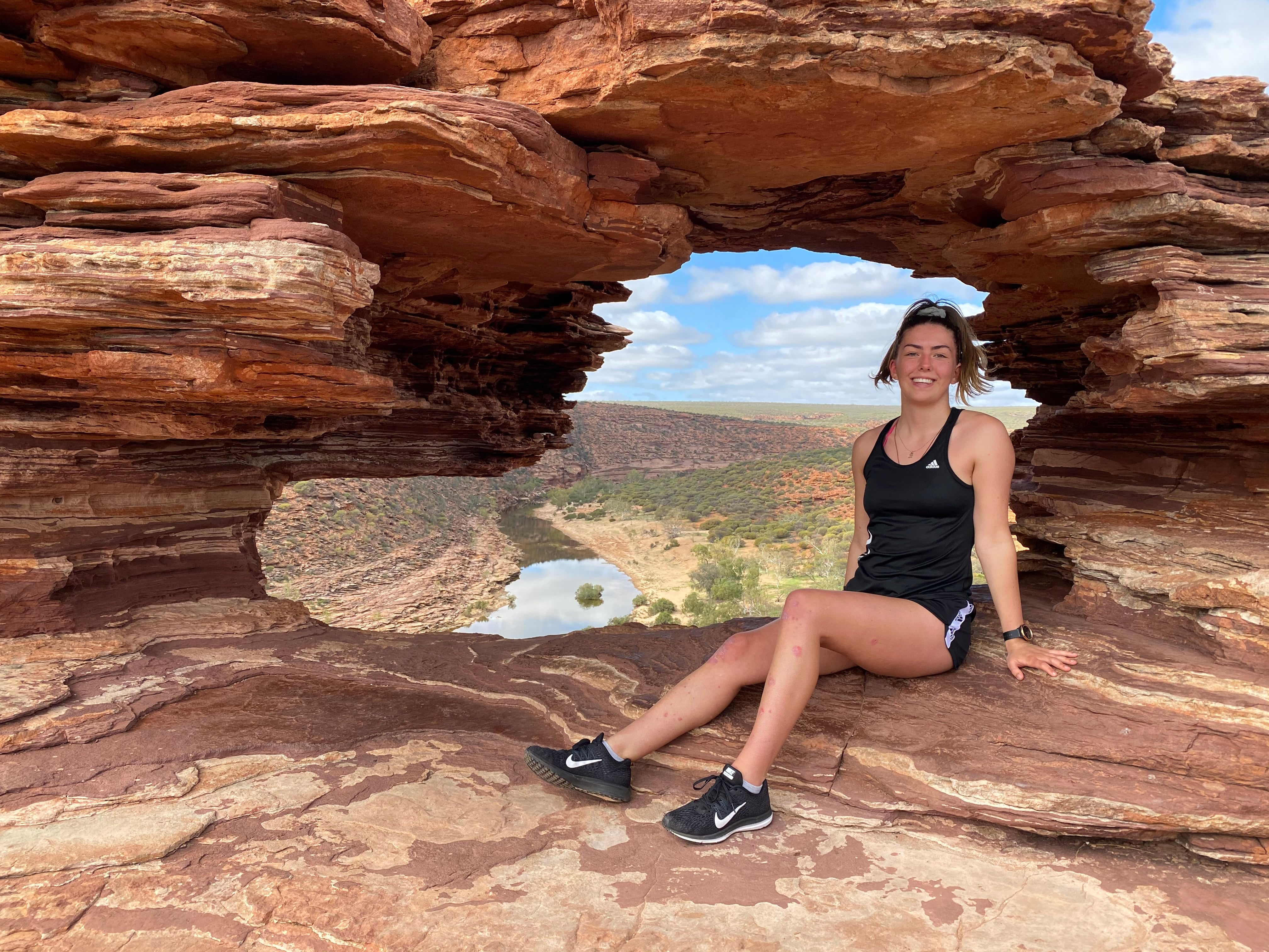 Guest Blog: Bree Pease Talks About Her Psoriasis - Psoriasis Honey